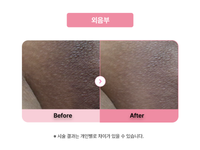 셀라닌/리핑크