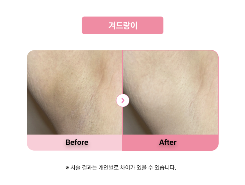 셀라닌/리핑크