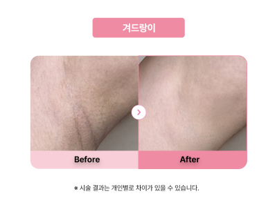 셀라닌/리핑크