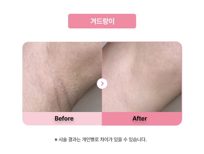 셀라닌/리핑크