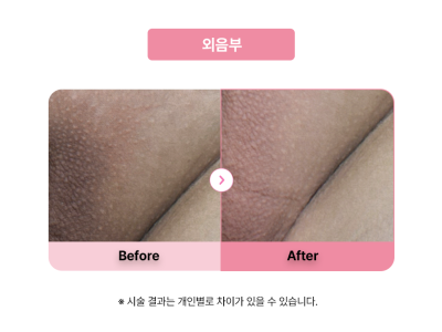 셀라닌/리핑크