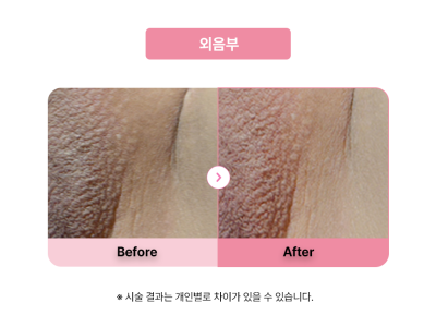 셀라닌/리핑크