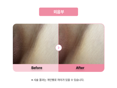 셀라닌/리핑크